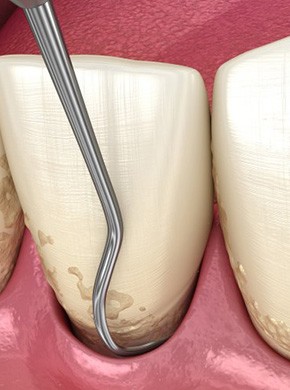 Illustration of teeth and gums receiving deep cleaning