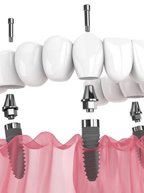 Close-up illustration of All-on-4 for lower dental arch