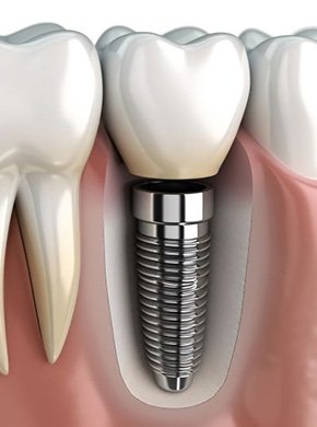 Digital image of single traditional dental implant