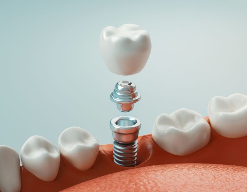 A dental implant
