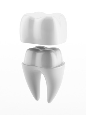 Illustration of a tooth and a dental crown